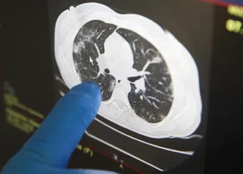 সিটিস্ক্যানে ক্যানসারের ঝুঁকি, কী বলছে গবেষণা