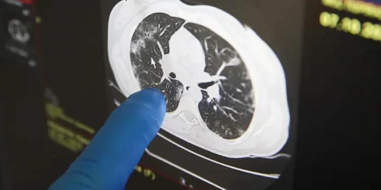 সিটিস্ক্যানে ক্যানসারের ঝুঁকি, কী বলছে গবেষণা