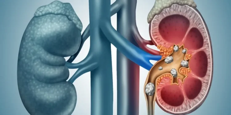 কিডনিতে পাথর থাকার ৫ লক্ষণ, যা বলছে চিকিৎসকরা