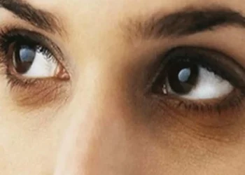 চোখের নিচে কালো দাগ দূর হবে ৩ সবজিতে