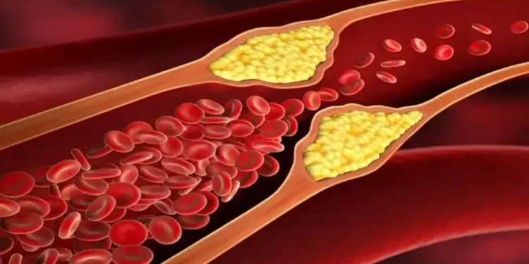যেসব লক্ষণে বুঝবেন শরীরে কোলেস্টেরলের মাত্রা বেড়েছে