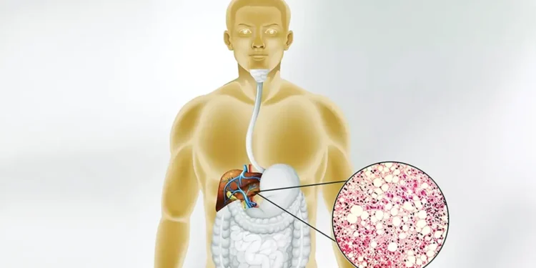 ‘মেটাবলিক অ্যাসোসিয়েটেড ফ্যাটিলিভার’ এক নীরব ঘাতক