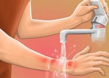 পুড়ে গেলে প্রথমেই যে চিকিৎসা নেবেন