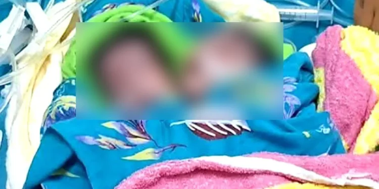 দুটি মাথা নিয়ে এক শিশুর জন্ম