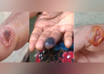 আশঙ্কাজনক হারে ছড়িয়ে পড়ছে পশুবাহিত এক অজানা রোগ