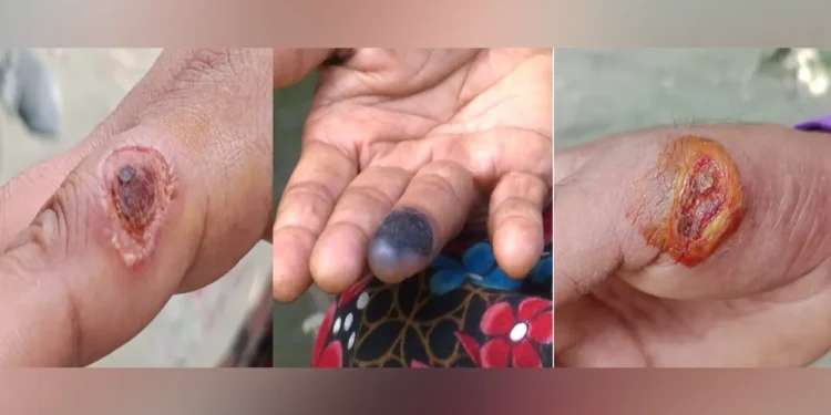 আশঙ্কাজনক হারে ছড়িয়ে পড়ছে পশুবাহিত এক অজানা রোগ