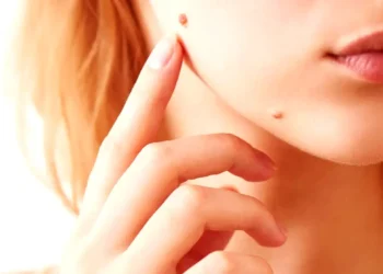 ঘরোয়া উপায়ে দূর করুন আঁচিল