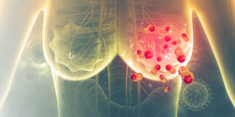 ব্রেস্ট ক্যানসার: জানুন কোন স্টেজে কী হয়