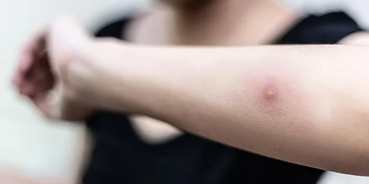 ত্বকে বিষফোড়া কাদের বেশি হয়? জেনে নিন সমাধান