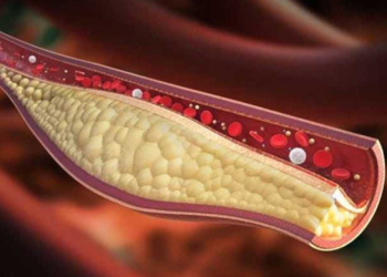 কোলেস্টেরল কমবে মাত্র ৩০ দিনে, জেনে নিন সহজ উপায়