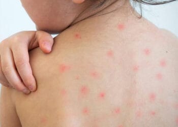 টিকা নেয়ার পরও কী হাম হতে পারে?