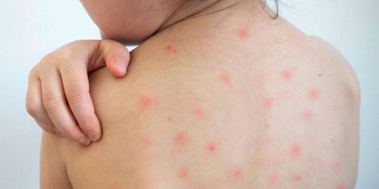 টিকা নেয়ার পরও কী হাম হতে পারে?