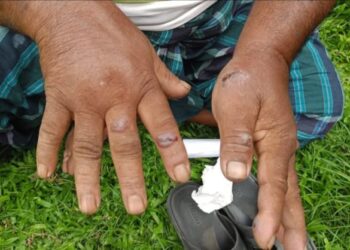 গাইবান্ধার সুন্দরগঞ্জে অ্যানথ্রাক্সের প্রকোপ, রংপুরে ক্লাস্টার ছড়ানোর আশঙ্কা