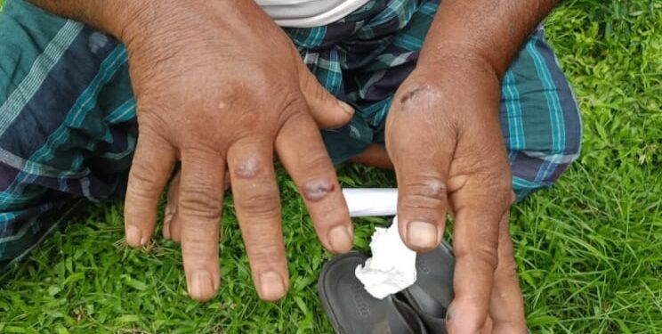 গাইবান্ধার সুন্দরগঞ্জে অ্যানথ্রাক্সের প্রকোপ, রংপুরে ক্লাস্টার ছড়ানোর আশঙ্কা